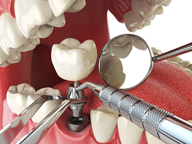 Best Emergency Tooth Extraction in Apple Valley, OH
